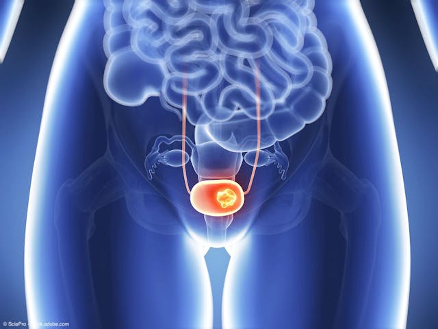 EV/pembrolizumab under review in China for advanced urothelial carcinoma