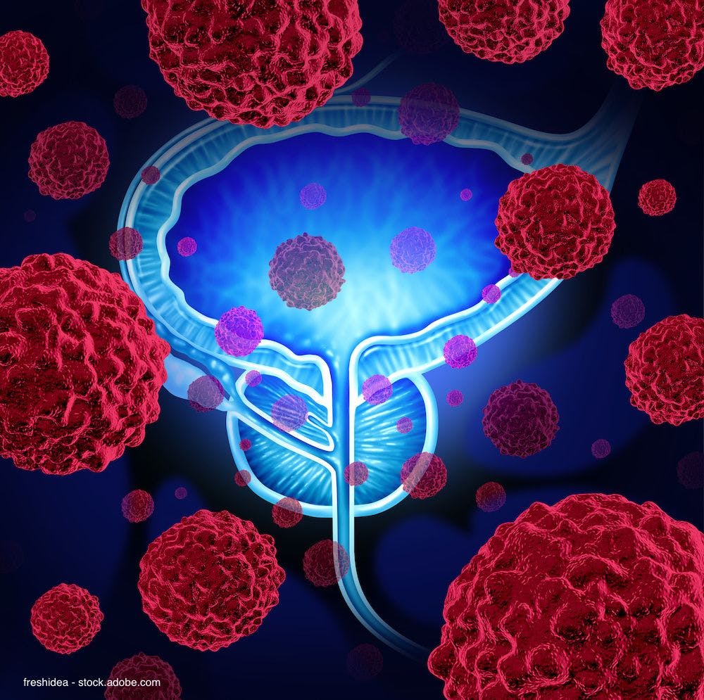 Hydrogel spacer may reduce rectal irradiation in patients receiving RT for prostate cancer