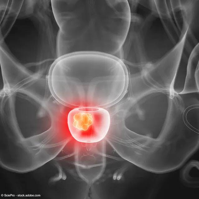 Longer prostatic urethra increases risk of AEs after prostate cancer radiation
