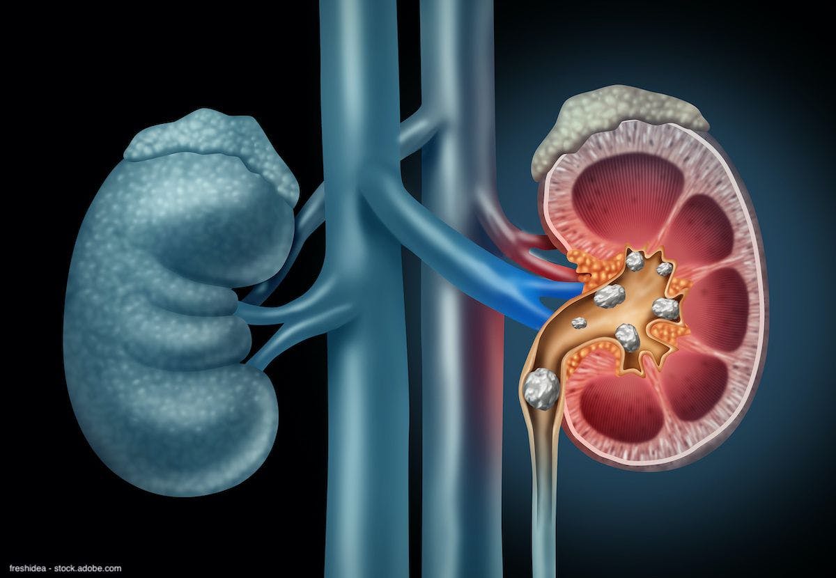 illustration of kidney stones