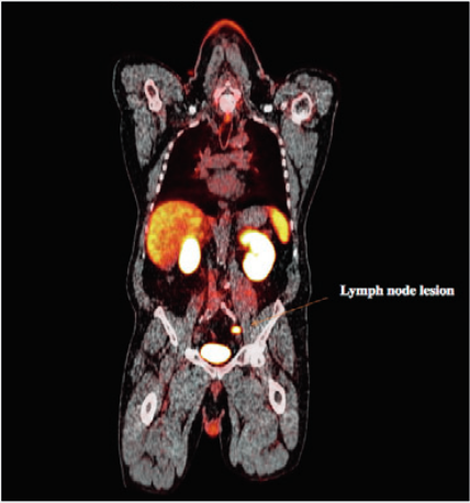 Prostate cancer imaging agent detects regional/distant metastases