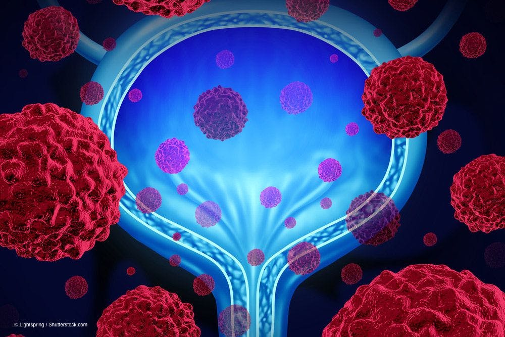 Upfront immunotherapy regimen falls short in bladder cancer
