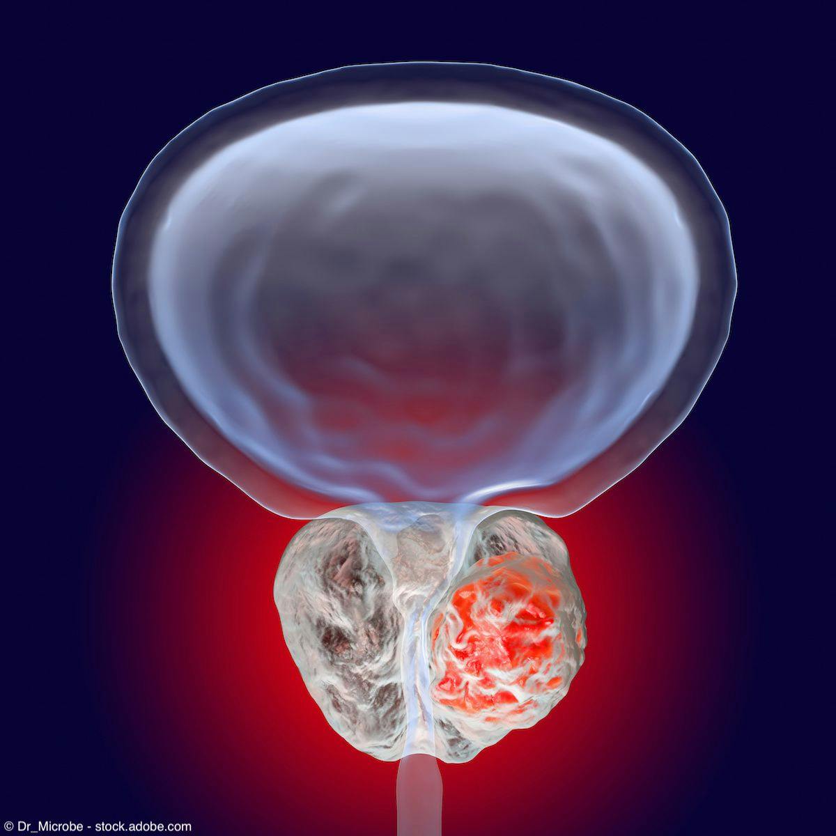 Prostate cancer, 3D illustration showing presence of tumor inside prostate gland which compresses urethra | Image Credit: @ Dr_Microbe - stock.adobe.com