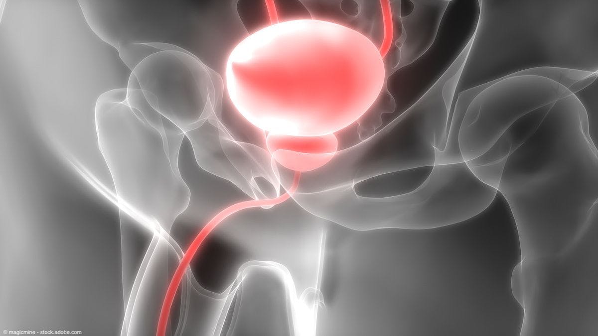 "Based on results from randomized phase 3 data, Balversa continues to demonstrate the promise of targeted therapy in the treatment of patients with advanced bladder cancer," said Kiran Patel, MD.
