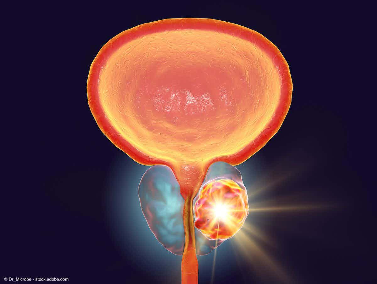 Conceptual image for prostate cancer treatment | © Dr_Microbe - stock.adobe.com