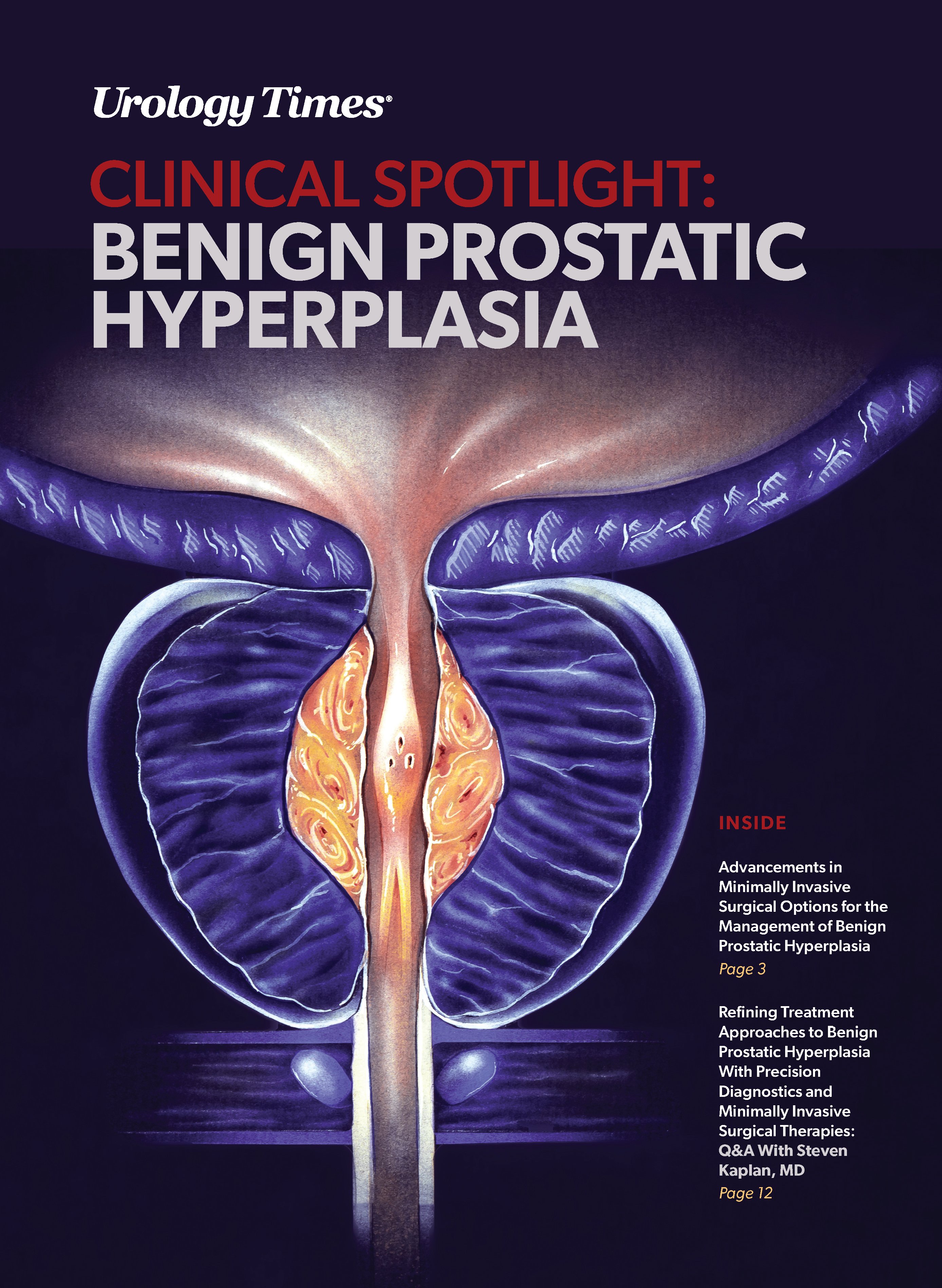 Clinical Spotlight: Benign Prostatic Hyperplasia