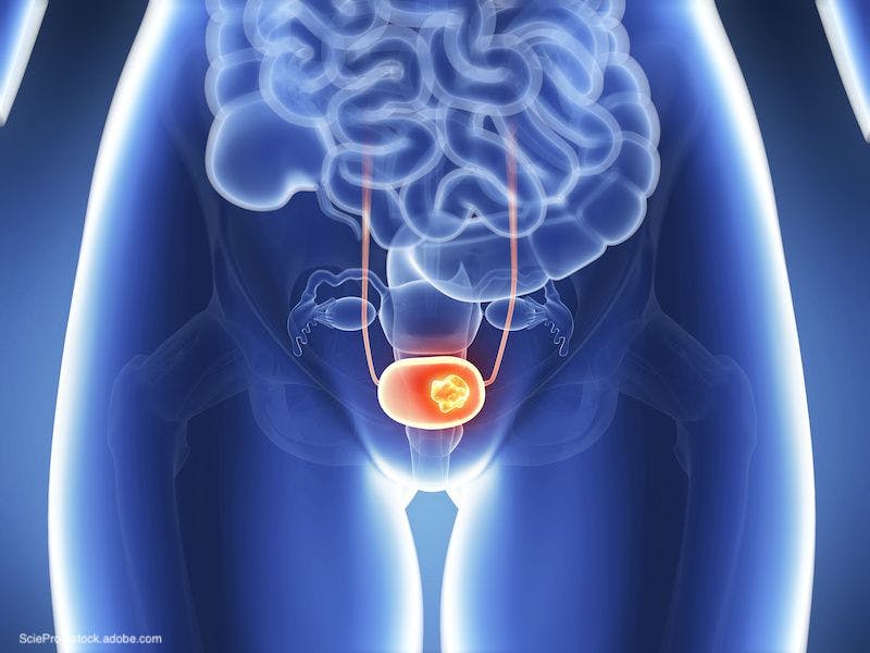 Biomarkers may be predictive of patient response to bladder cancer treatments