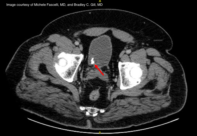 Challenging cases in urology: Persistent ureteral stone in a 76-year-old male