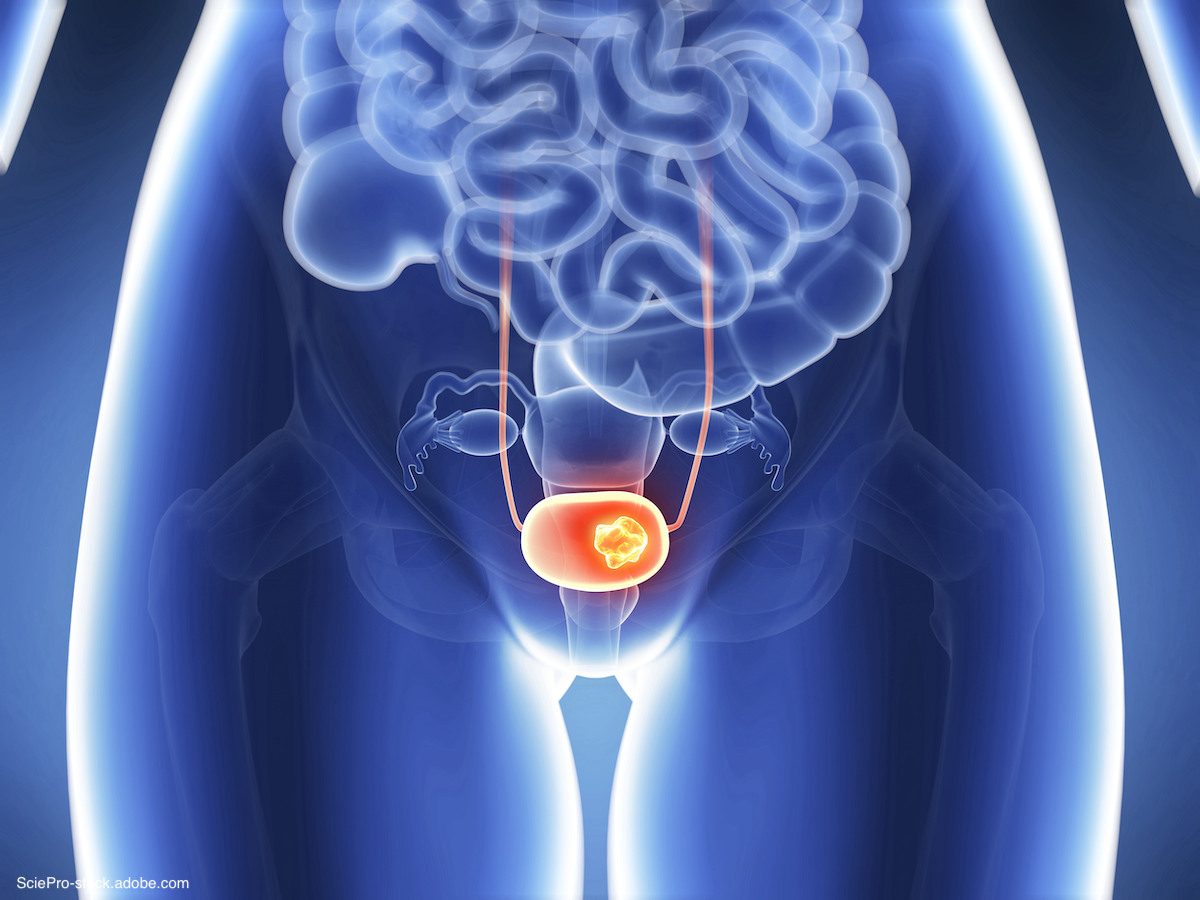 medical depiction of a blue xray of bladder cancer
