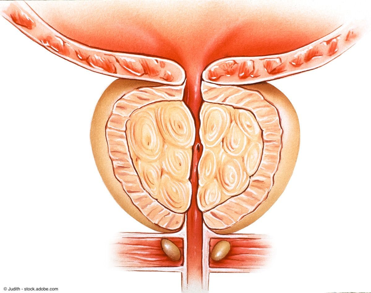 Illustration of Benign Prostatic Hyperplasia | Image Credit: © Judith - stock.adobe.com
