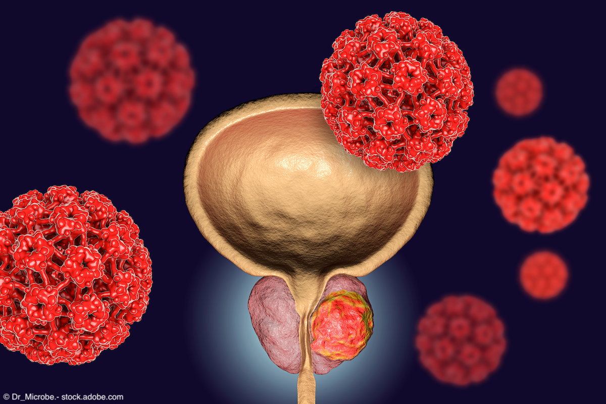 conceptual medical depiction of prostate cancer