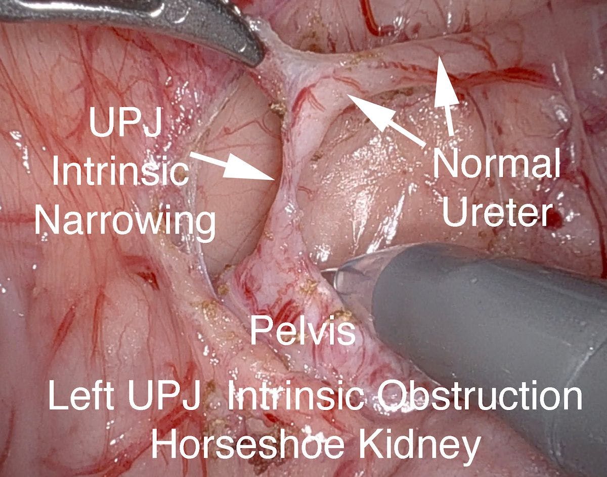 Figure 2. Left UPJ intrincsic UPJ horseshoe kidney