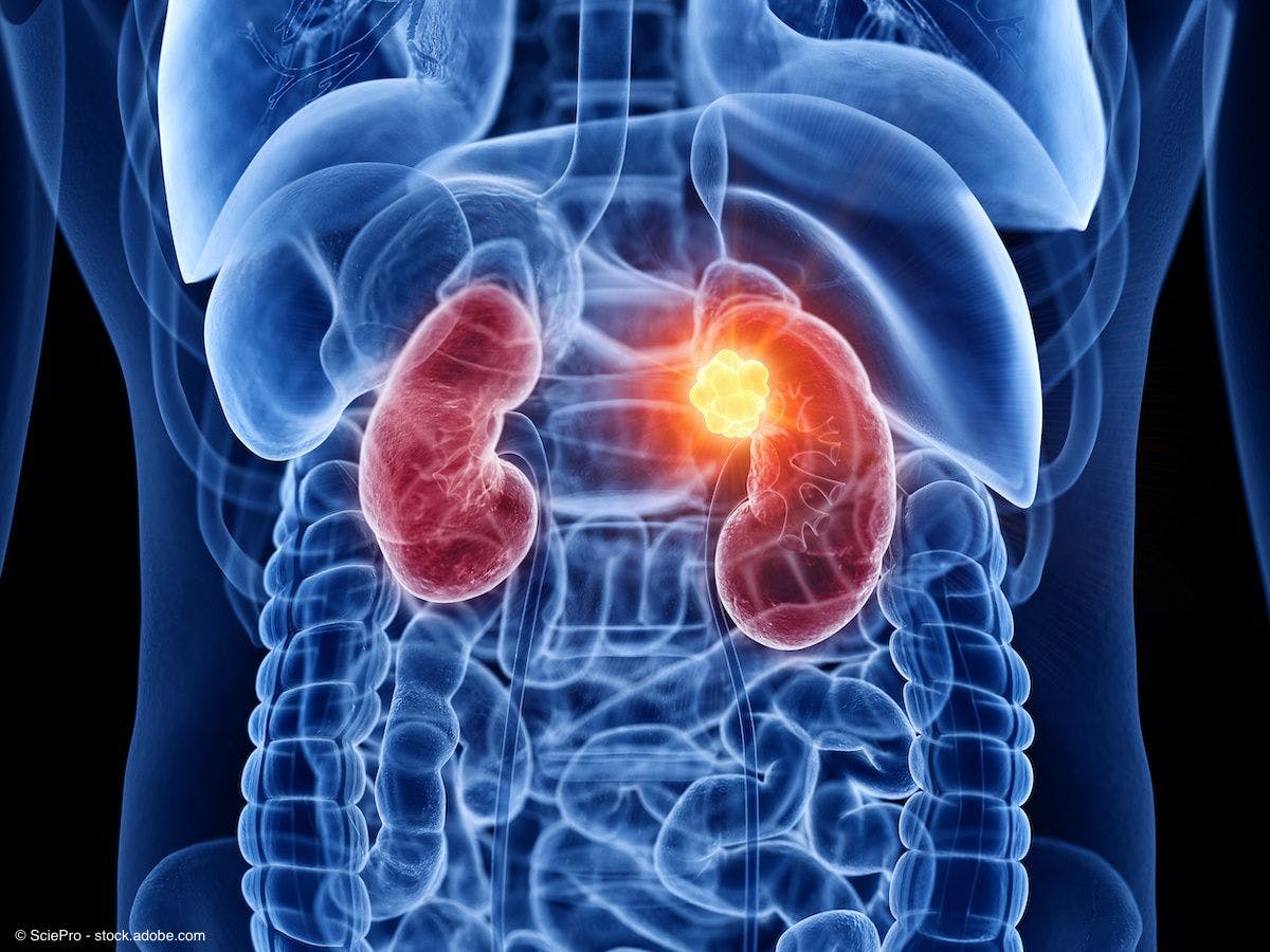 image of kidneys with tumor one of the kidneys