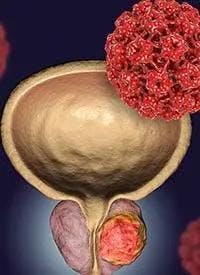 If approved in the European Union for prostate cancer of this type, olaparib in combination with abiraterone will provide a much-needed new treatment option for the many men with this condition,” said Noel Clarke, MBBS, FRCS, ChM.