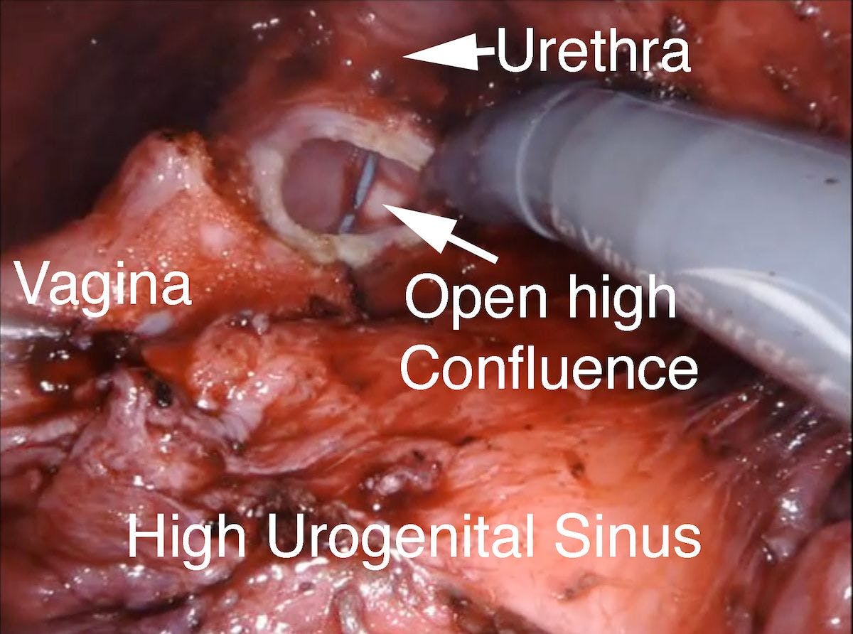 Figure 7B. High urogenital sinus