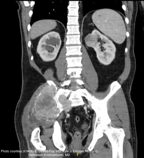 Challenging case: A large ‘ticking’ back lipoma and a small renal mass