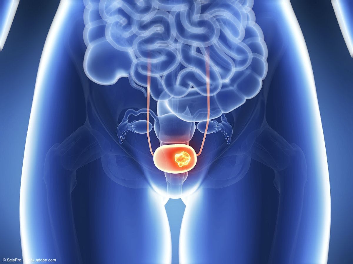 medical depiction of bladder cancer on an xray