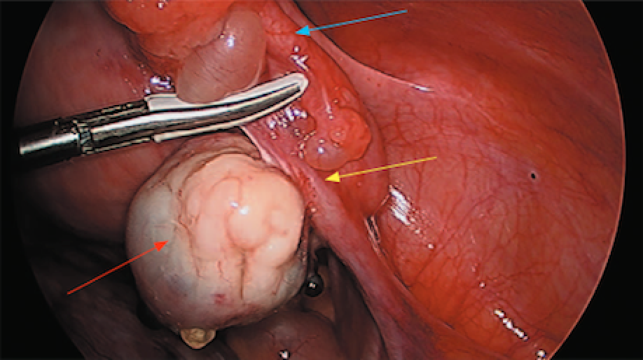 Opportunistic salpingectomy in female urologic surgery