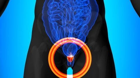 Evidence mounts that rise in metastatic prostate cancer is linked to PSA screening reduction