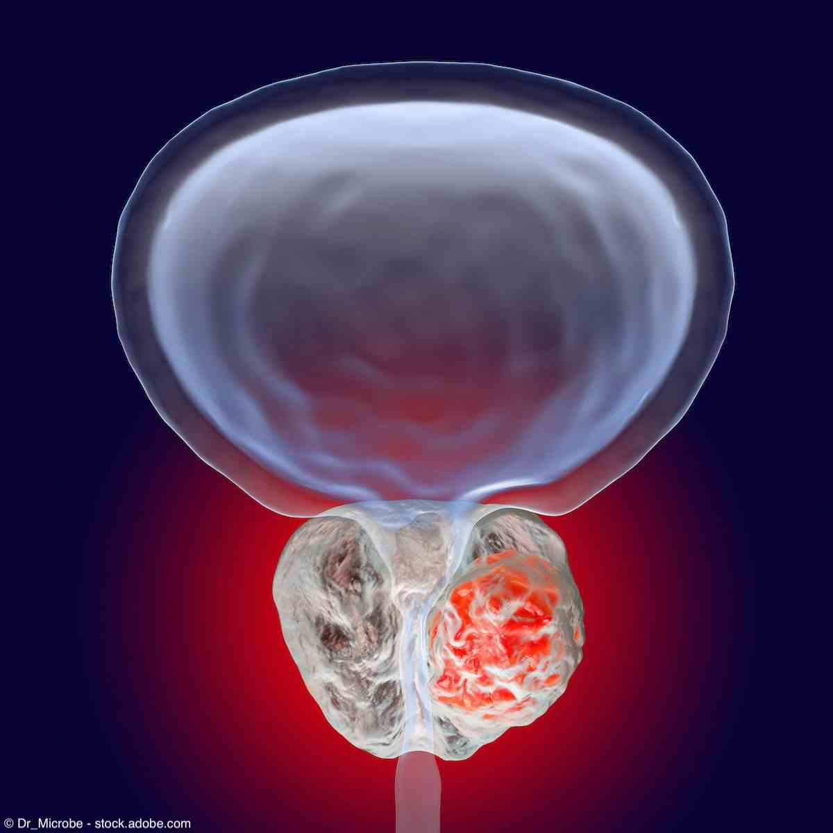 Prostate cancer, 3D illustration showing presence of tumor inside prostate gland which compresses urethra | Image Credit: © Dr_Microbe - stock.adobe.com