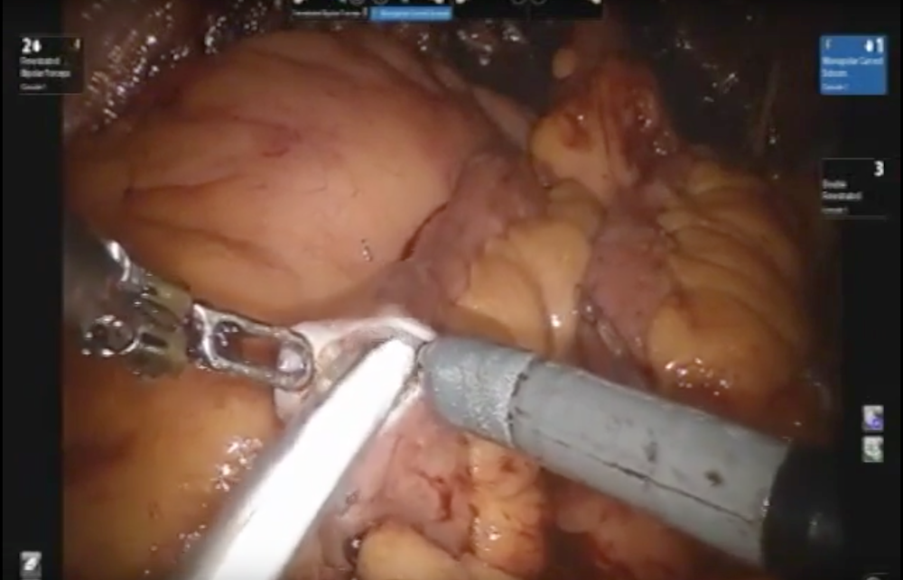 Robotic cystectomy: Intracorporeal neobladder using Studer technique