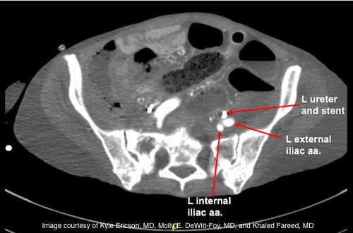 Challenging case: Persistent hemorrhage following ureteral stent exchange