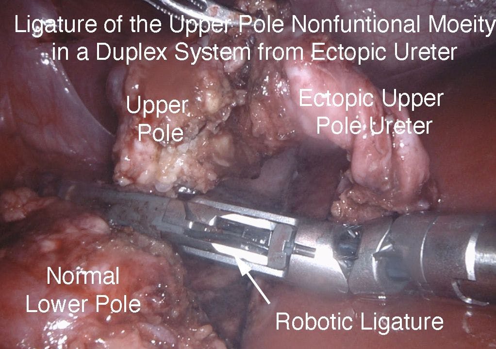 Figure 5B. Ligature upper pole ureter