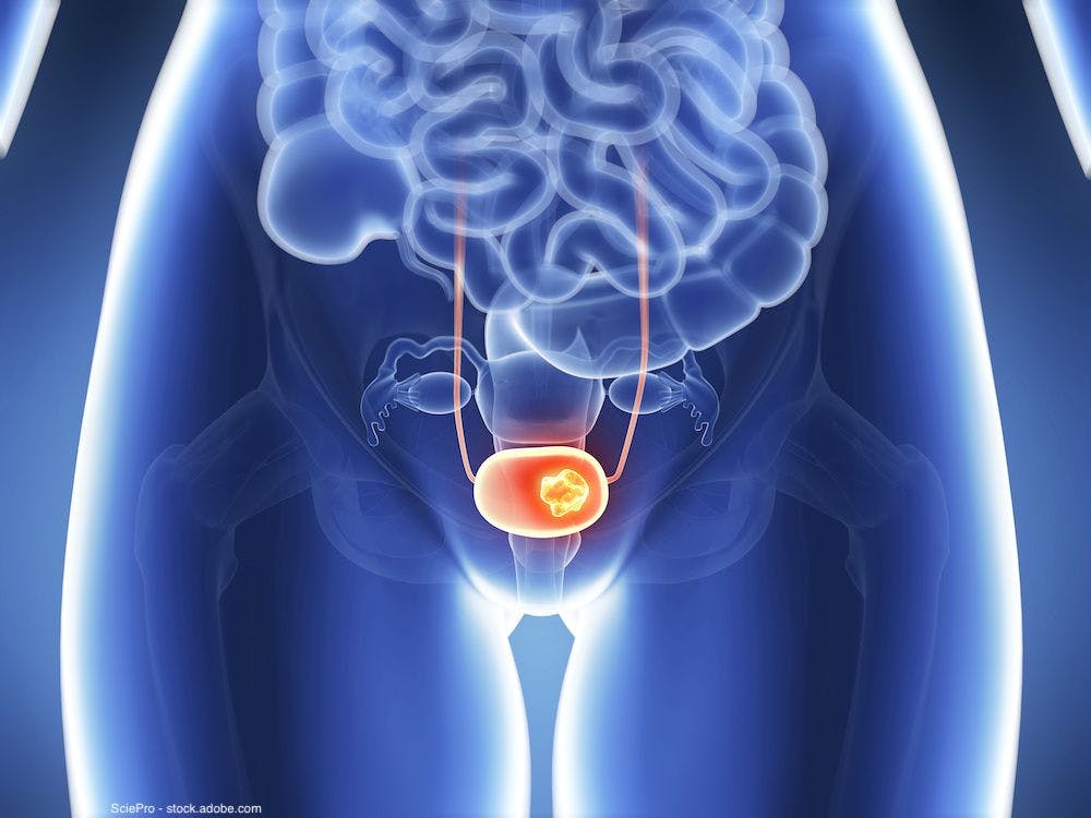 Combo of nivolumab and novel oncolytic immunotherapy explored in bladder cancer