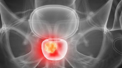 Prostate tumor size often underestimated by MRI