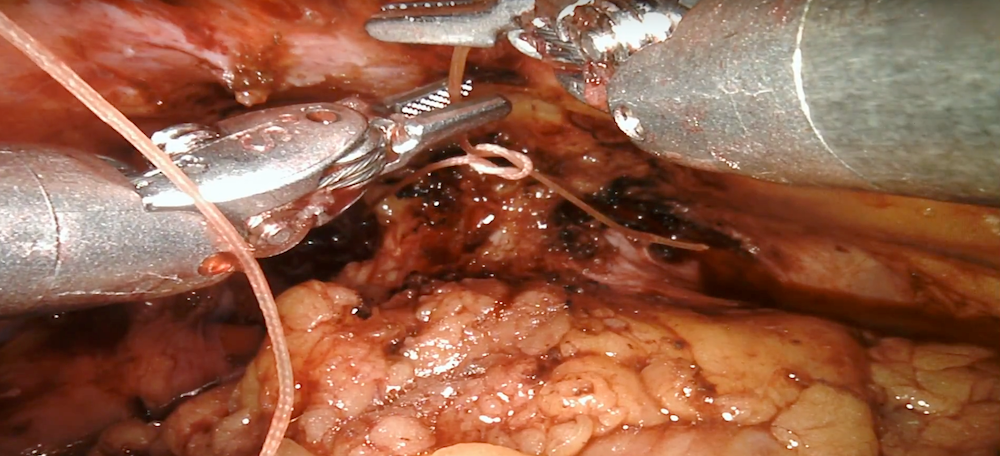 Robotic cystectomy: Ileal conduit