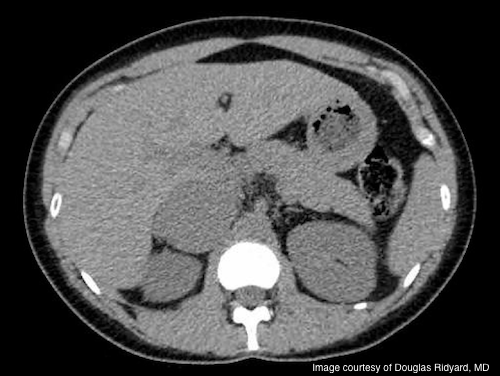 Challenging case: A young woman presenting with rapid weight gain