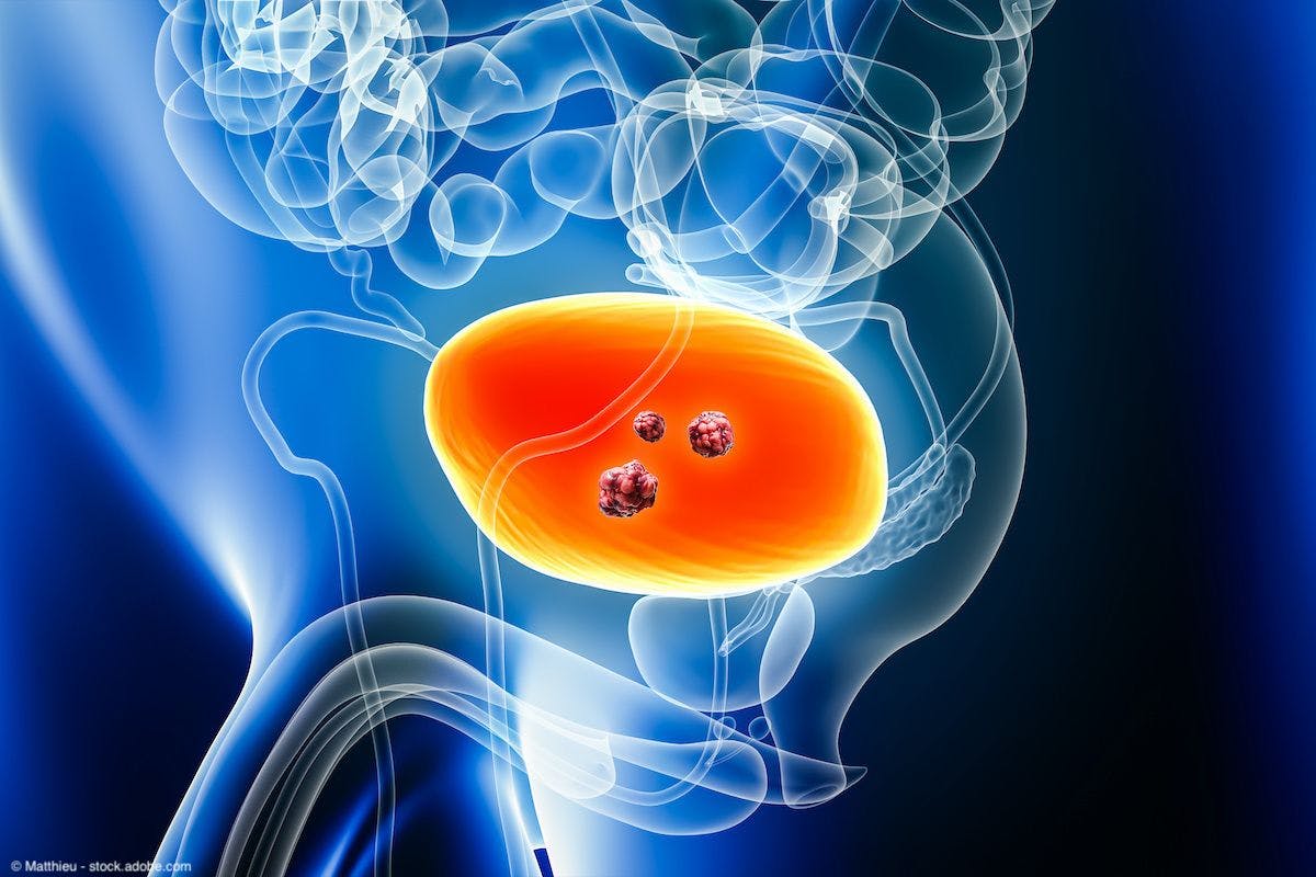Urinary bladder cancer with tumors/cells | Image Credit: © Matthieu - stock.adobe.com