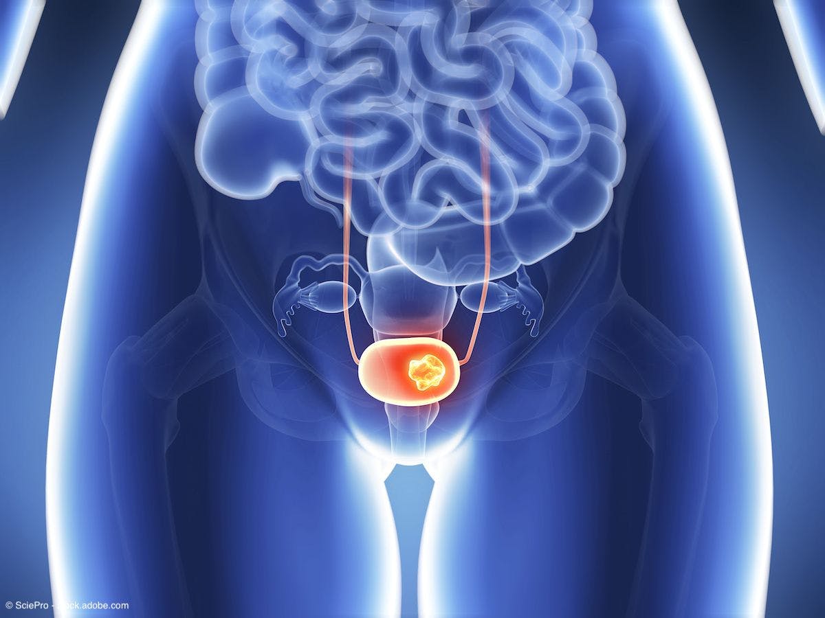 medical depiction of bladder cancer on xray