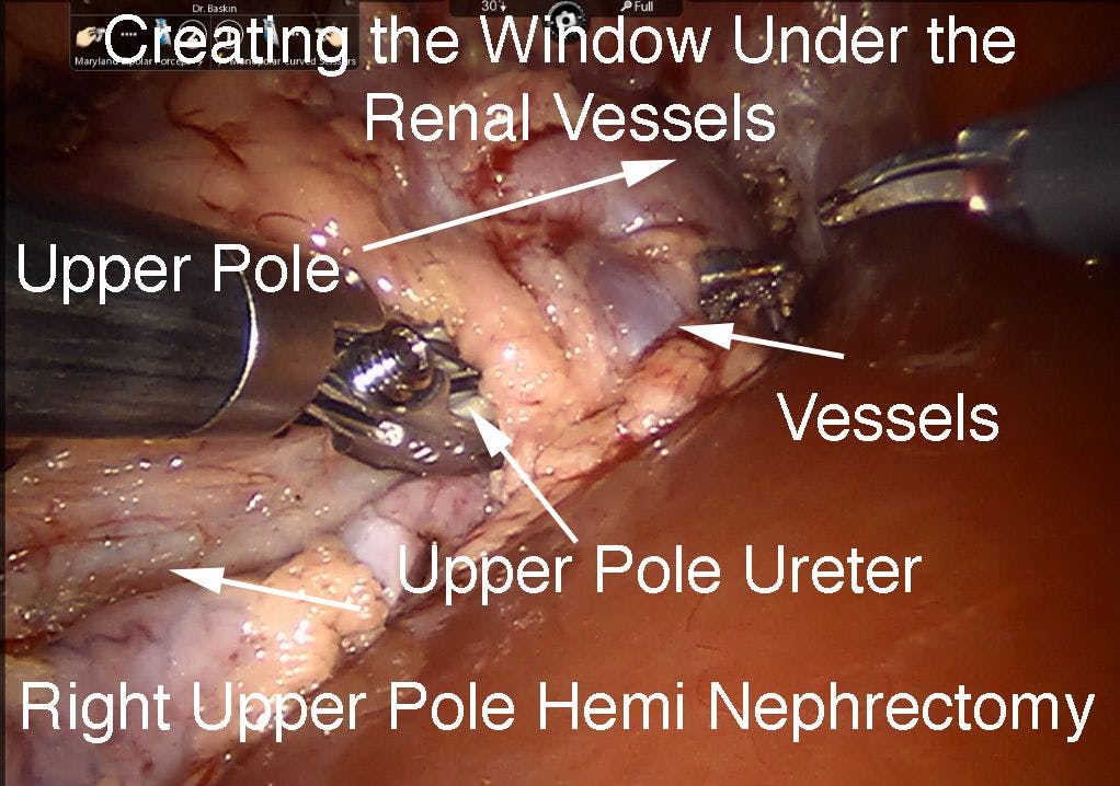Figure 5A. Upper pole heminephrectomy window
