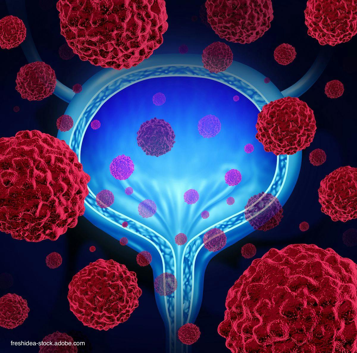 Illustration of bladder and bladder cancer cells