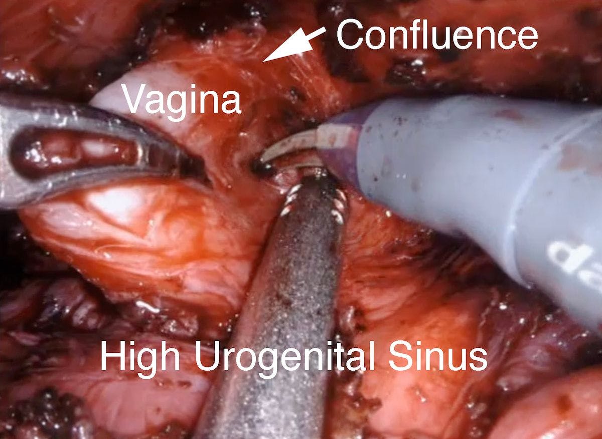 Figure 7A. High urogenital sinus