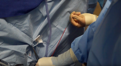 Ureteroscopy: Surgeons show techniques, tips in videos