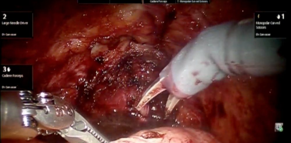 Robotic cystectomy: Y-shaped neobladder technique