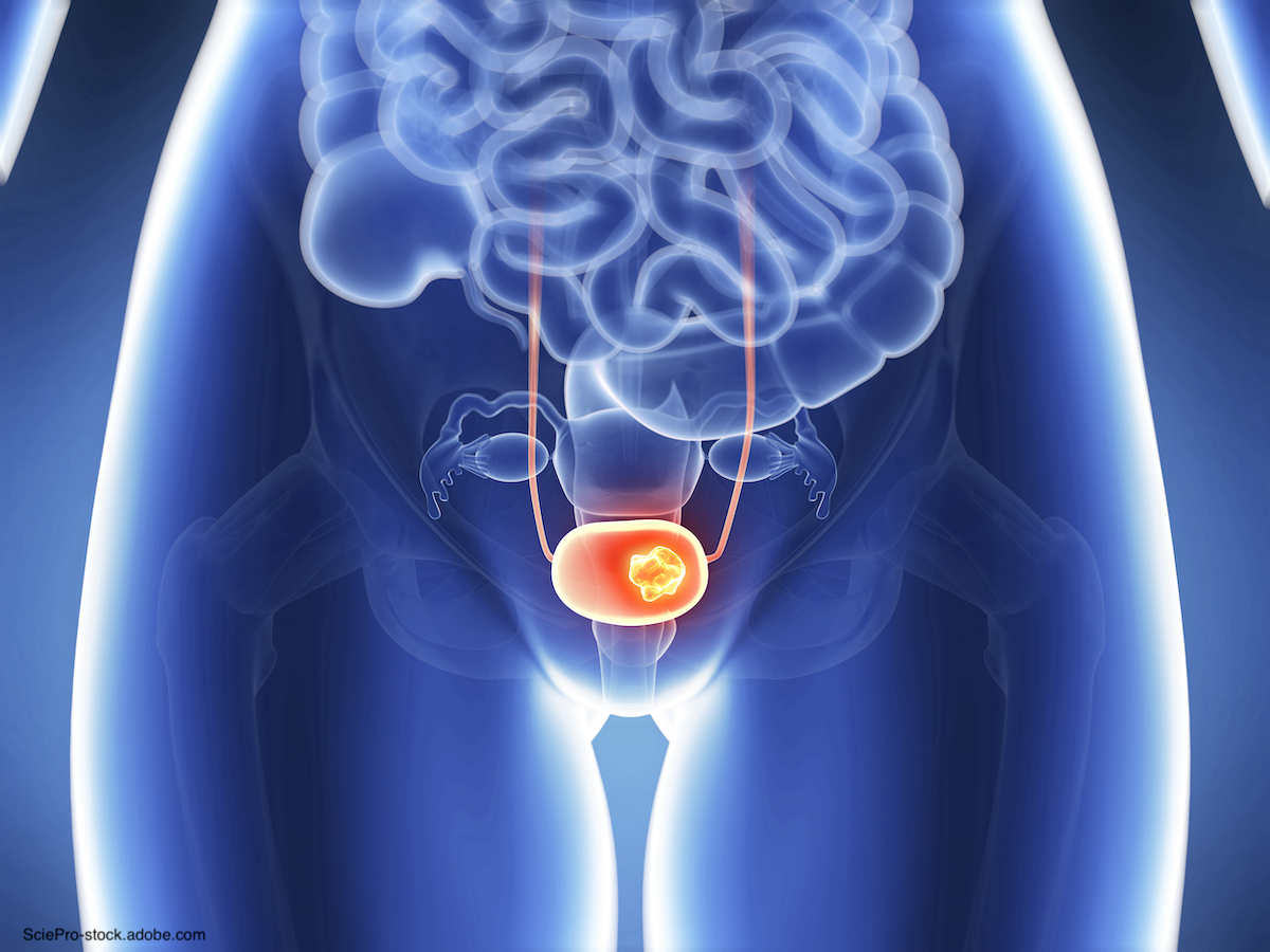 3D rendition of bladder cancer
