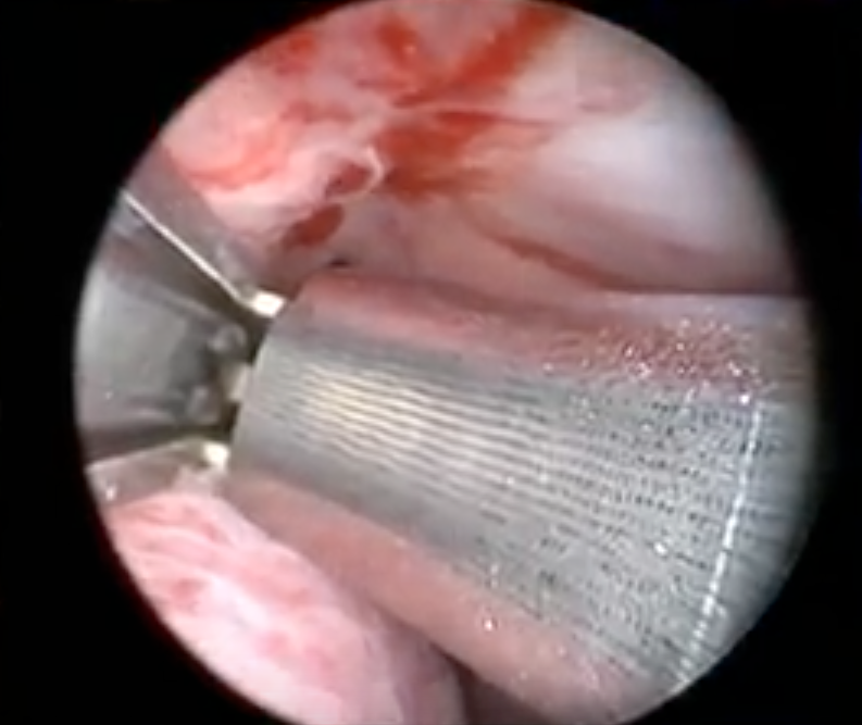 Placement of urethral lift (UroLift) under topical anesthesia