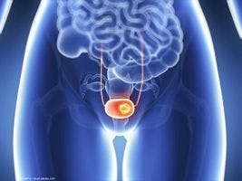 Study shows limitations of cystoscopy in detecting bladder cancer