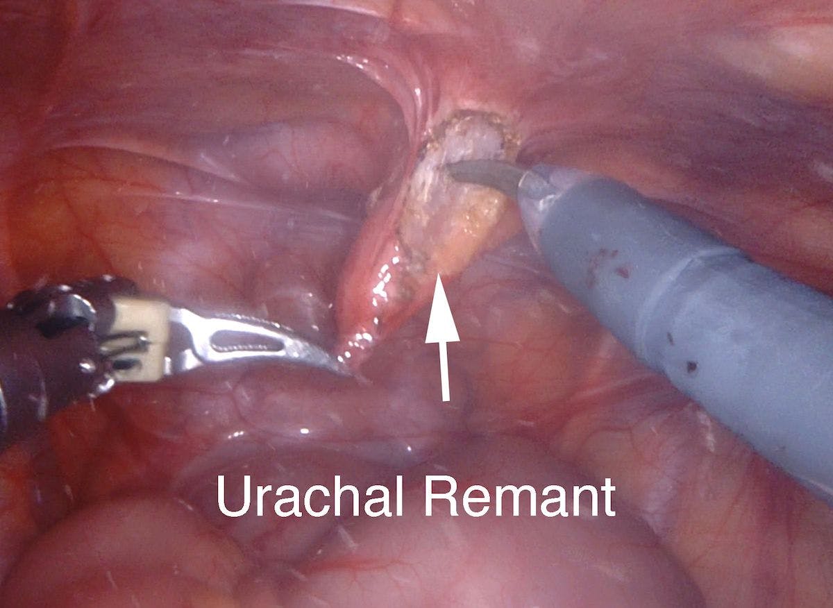 Figure 6. Urachal remnant