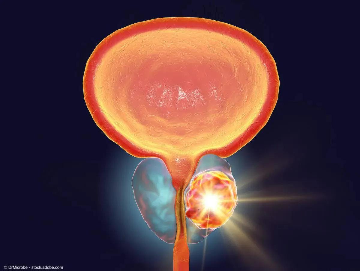 Conceptual image for prostate cancer treatment, 3D illustration showing destruction of a tumor inside prostate gland | Image Credit: @ Dr_Microbe - stock.adobe.com 