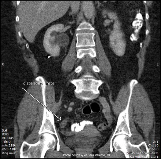 Challenging cases in urology: A case of hydronephrosis, sepsis, and pain