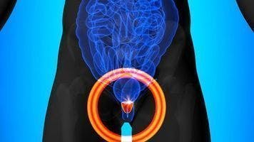 Rezvilutamide/ADT combo boosts survival in hormone-sensitive prostate cancer