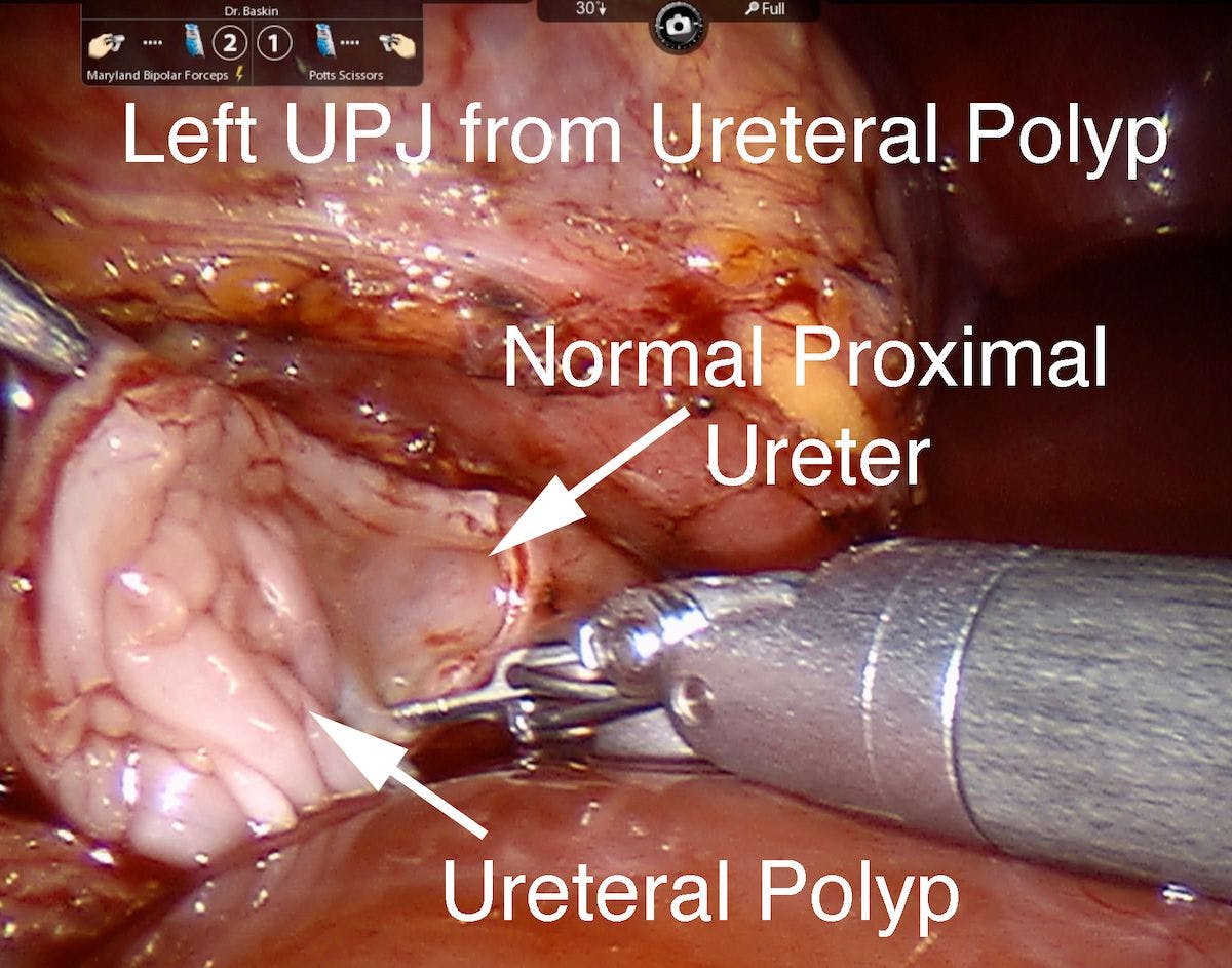 Figure 4. left ureteral polyp UPJ