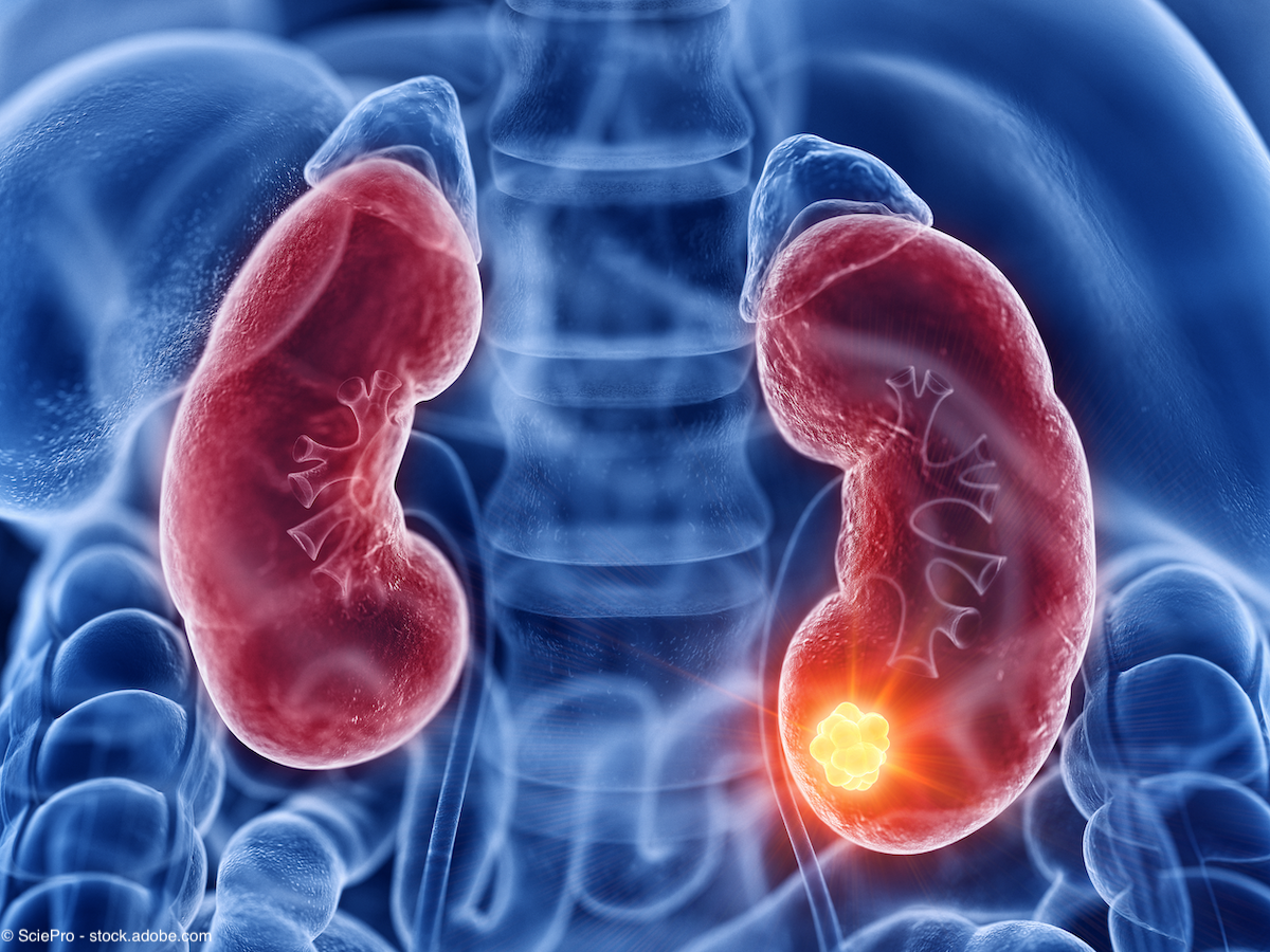 ctDNA emerging as biomarker to guide treatment decisions in renal cell carcinoma