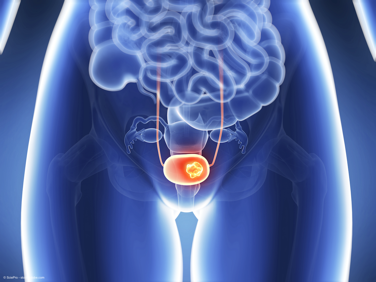 medical depiction of a blue xray of bladder cancer