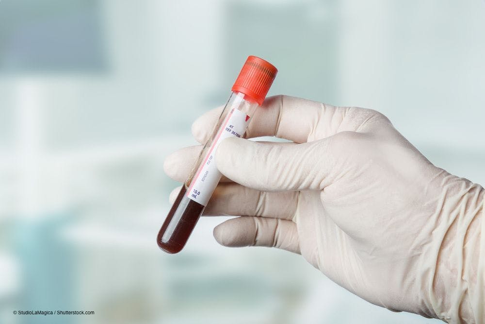 Novel blood test enhances prostate cancer screening
