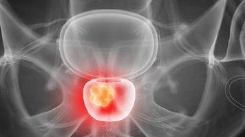 PSMA-targeted therapy shows early promise in locally advanced prostate cancer